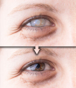 Two closeups of a woman’s eye, with an arrow between them, indicating the passage of time. In the top image, the woman’s eye is cloudy due to cataracts. In the second, the cloudy natural lens has been replaced with a synthetic lens and the woman’s eye is now clear.